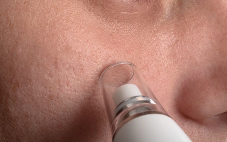 How to Use a Blackhead Remover